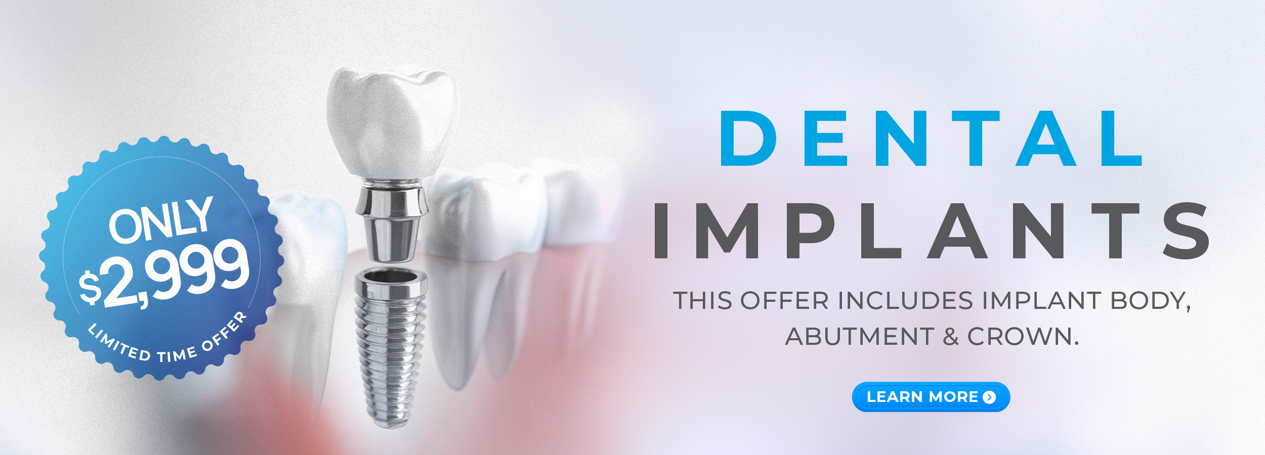 Dental Implant