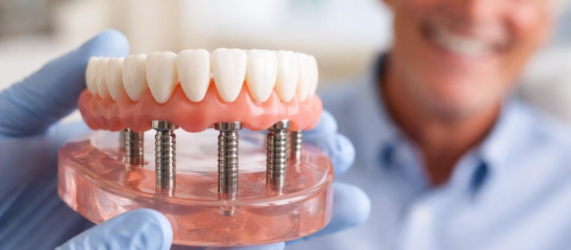 All on 4 Dental Implants: Complete Guide for Texas Families