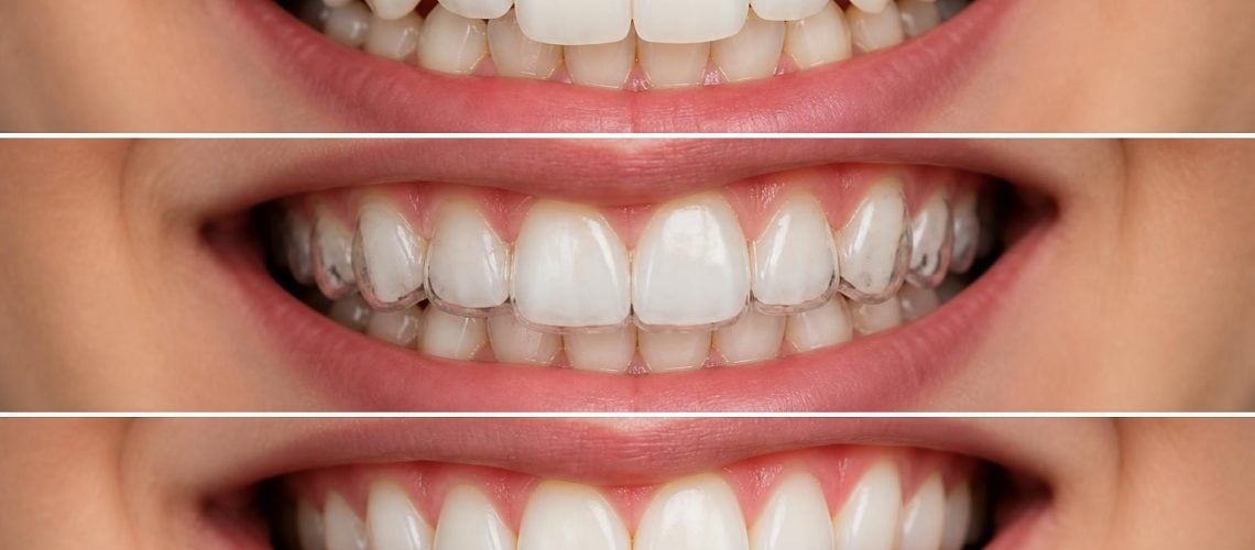 Can Clear Aligners Fix Crowded Teeth? Expert Guide 2026