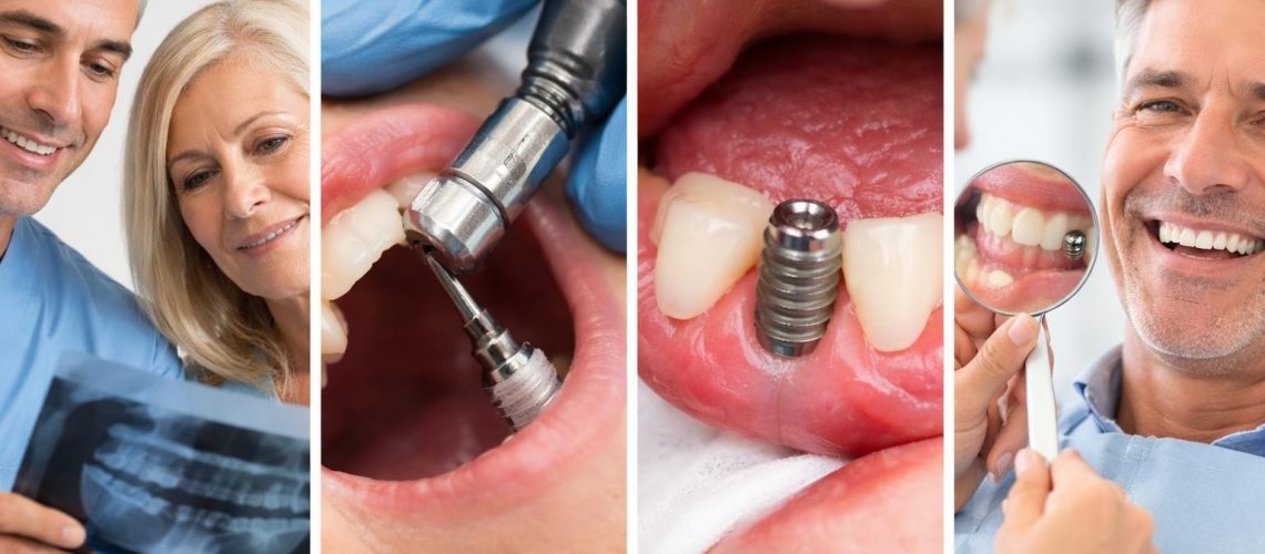 Dental Implant Success Rate: What You Need to Know in 2026