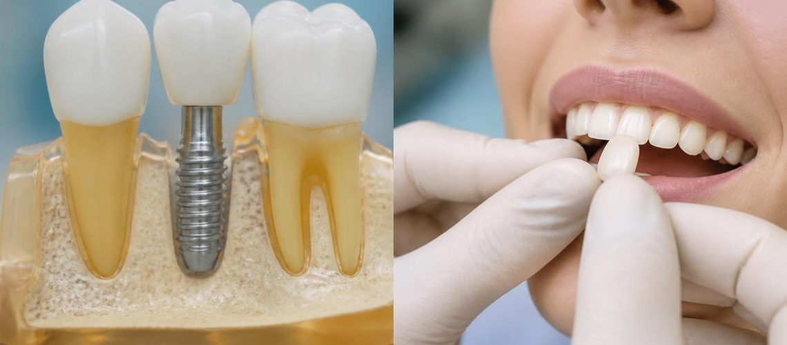 Dental Implants vs Veneers for Missing Teeth | Guide 2026