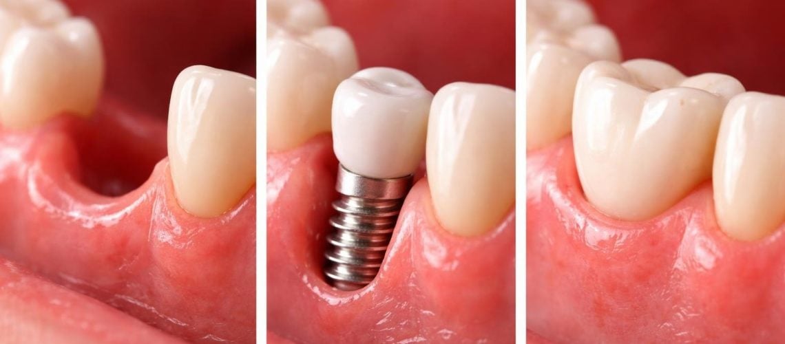 Zirconia Dental Implants: A Complete Guide for 2026